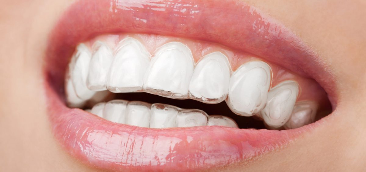 ¿Sonrisa Perfecta Sin Brackets? Descubre La Ortodoncia Invisible