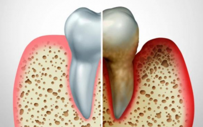 Dental bone loss, how to prevent it?